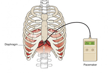 diaphragm pacing