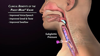 Clinical Benefits of the Passy Muir Valve