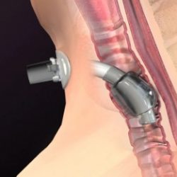 Animation of a Trachestomy Tube