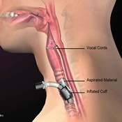 Cuff Misconceptions